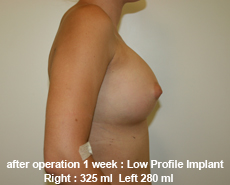 plastic-surgery-breast-augmentation